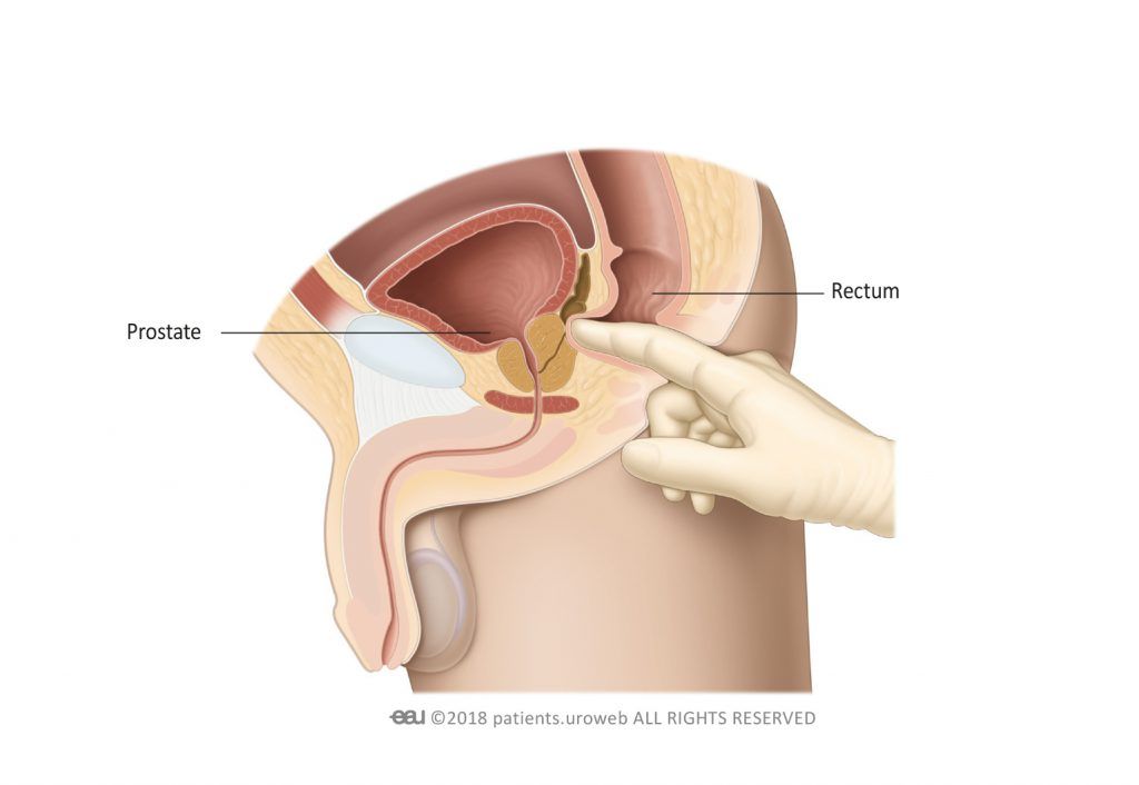 Fig. 2: Digital rectal examination male.