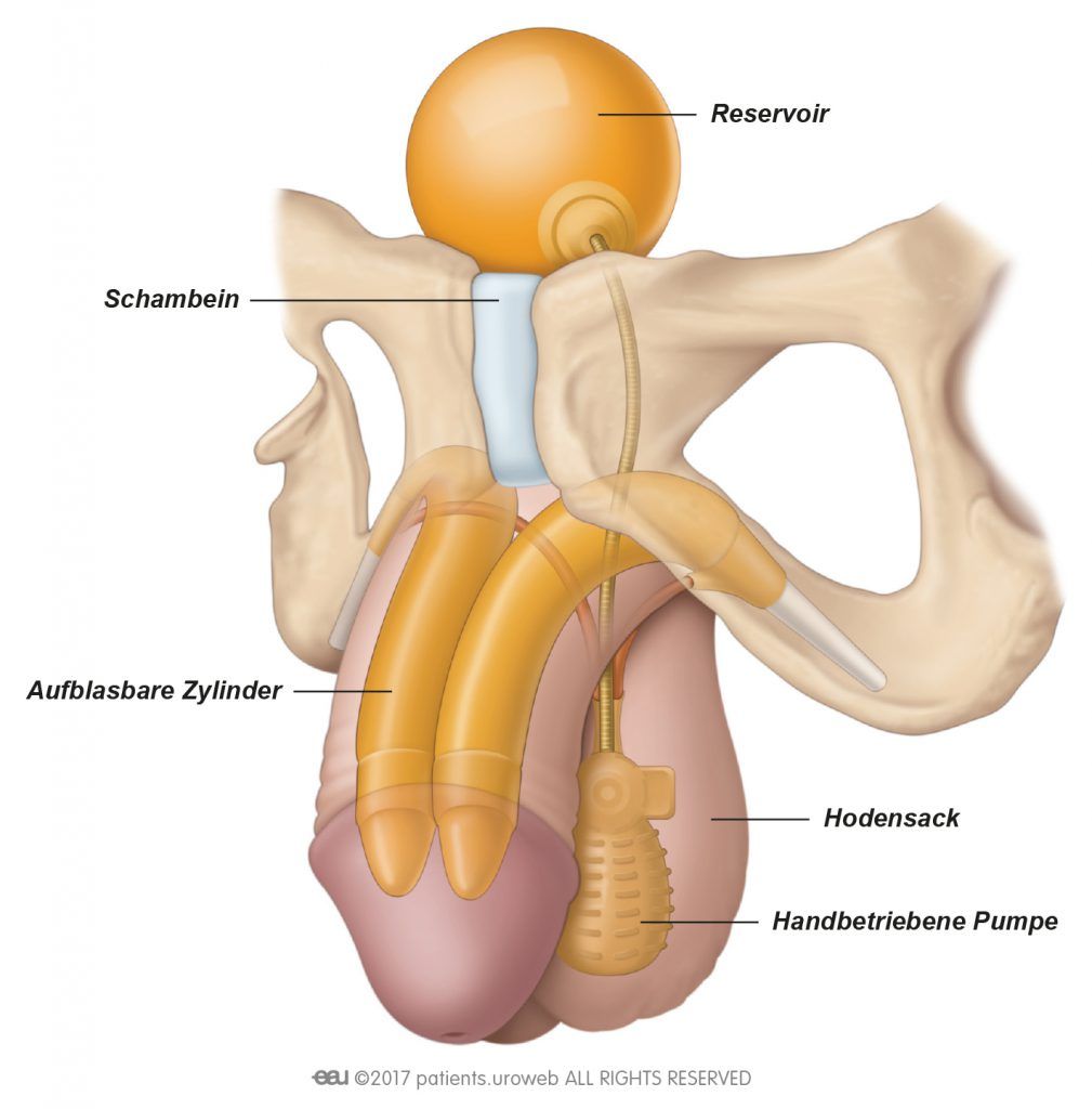 Fig. 1: A common type of inflatable penile implant.